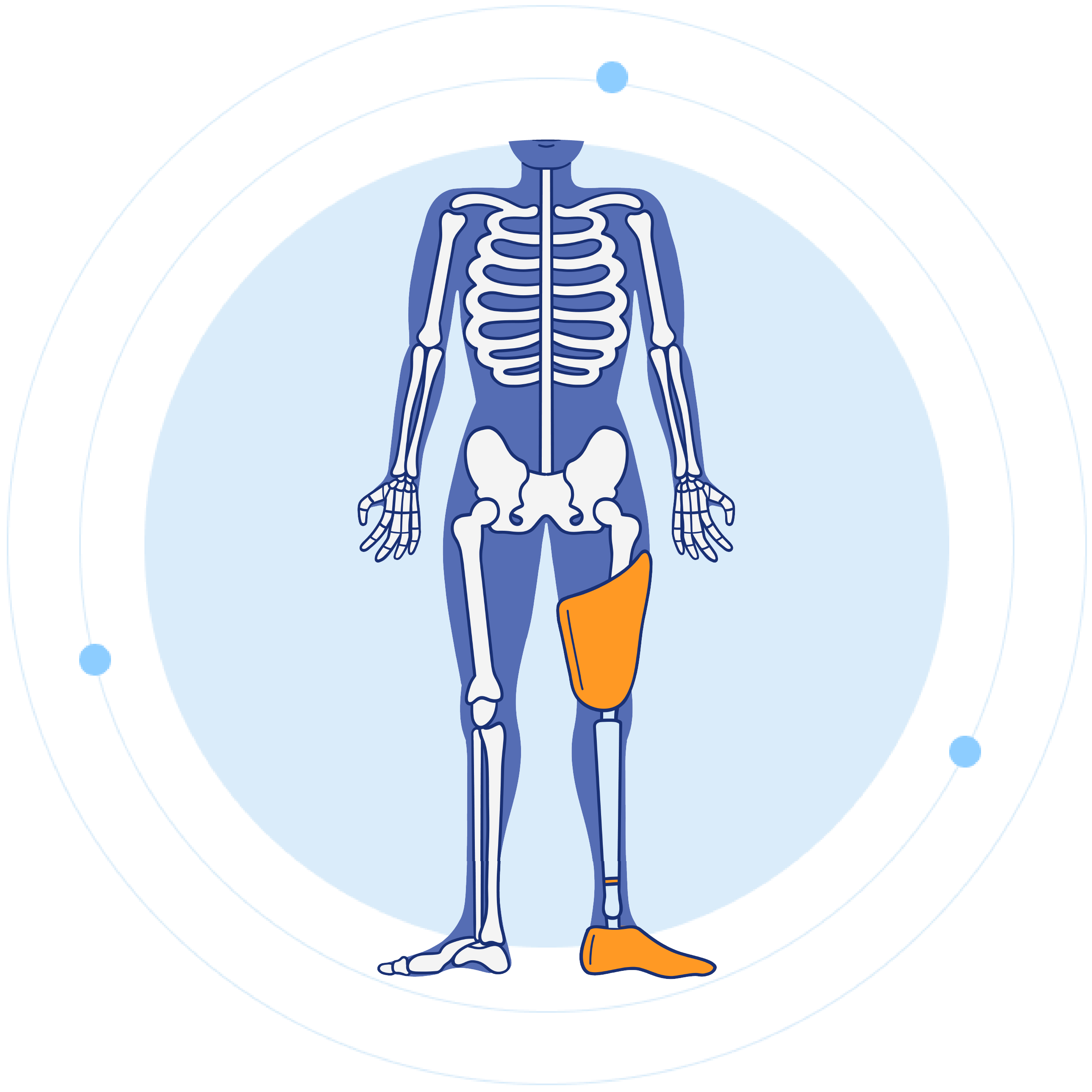 Through Knee Prosthetics