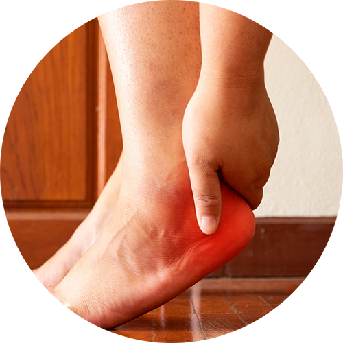 plantar fasciitis